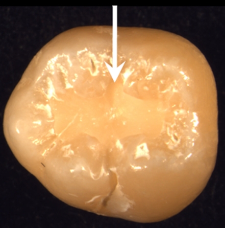 calcium phosphate nanocomposite filling in a tooth